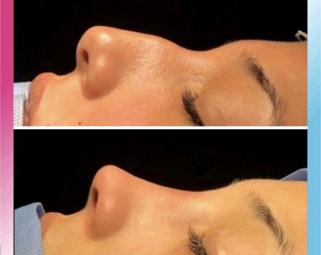 Nasenkorrekturen und Nasenoperationen