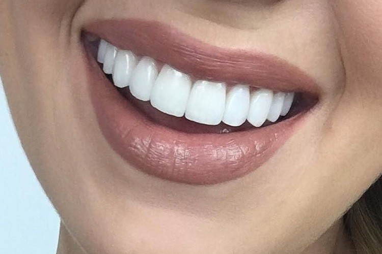 ZAHNVENEERS
